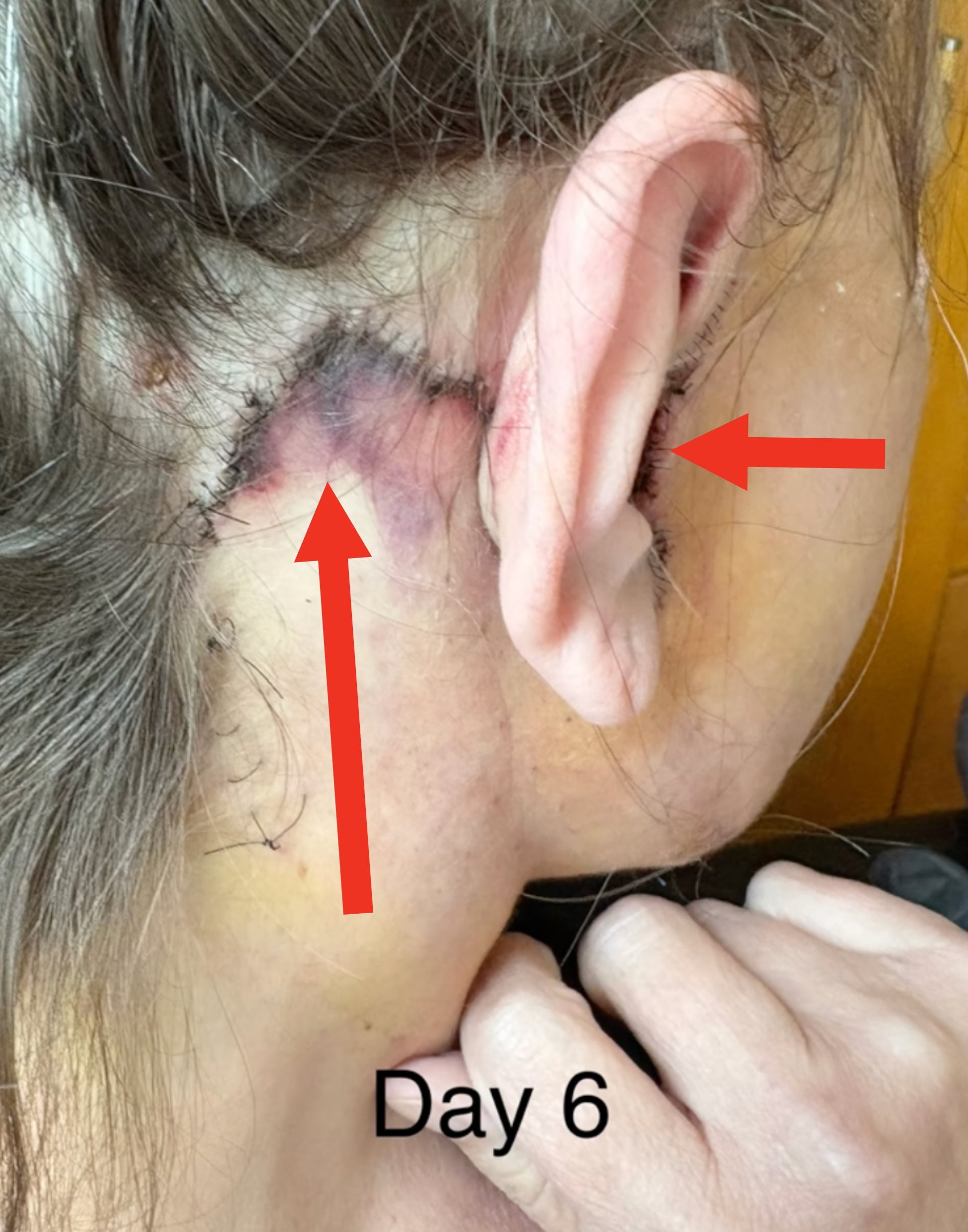 Healing stitches behind ear, six days post-surgery, with visible bruising and swelling