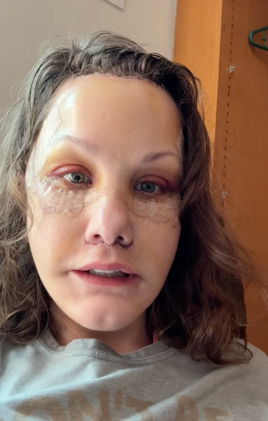 Person with visible medical bandages on face, speaking directly to the camera in a casual setting