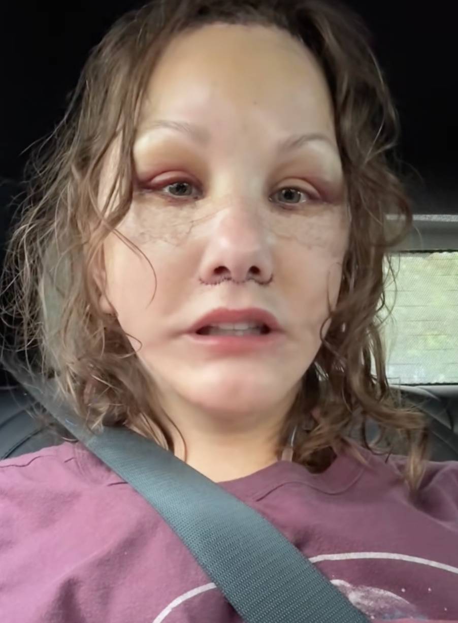 Person in a car wearing a seatbelt, with visible bruising around the eyes, looking directly at the camera