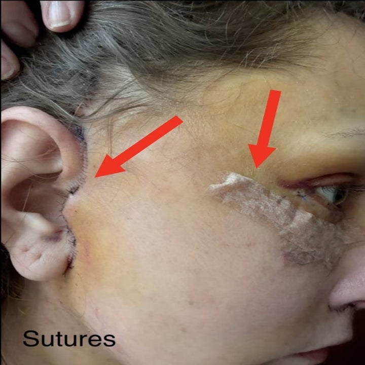 Close-up of a person's face showing sutures with arrows pointing to healing areas near the ear and eye. Tape secures the healing skin