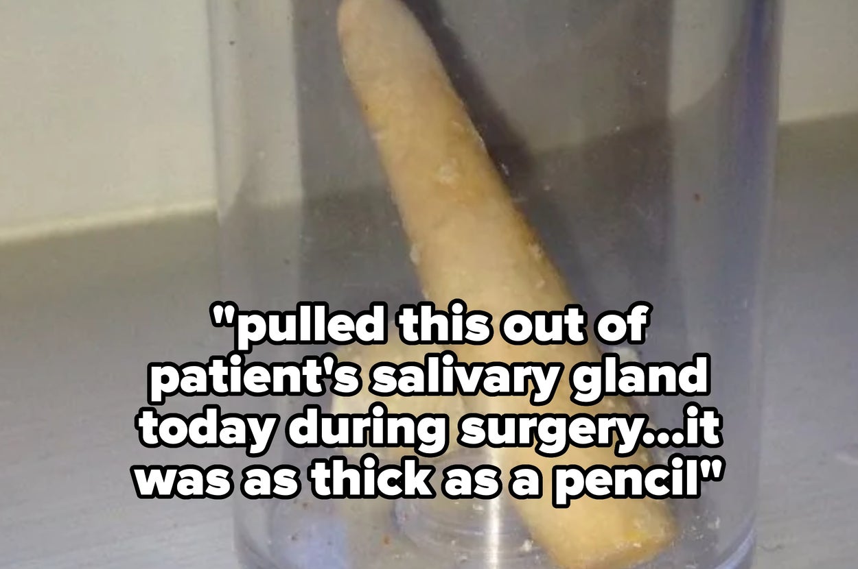 A cylindrical object, described as being as thick as a pencil, reportedly removed from a salivary gland during surgery