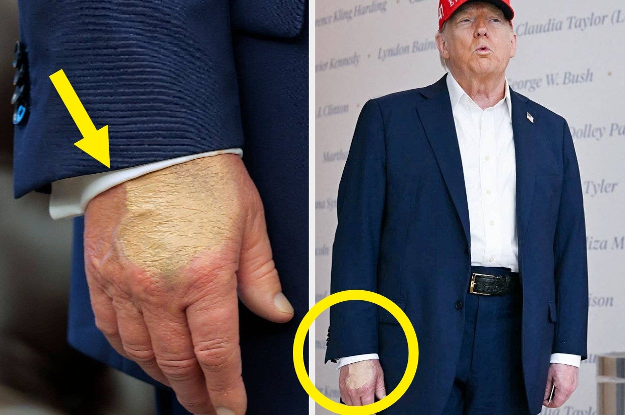 Close-up of a man's hand with a visible bruise next to a full-body shot of the man in a suit, white shirt, and red cap, highlighting the same hand