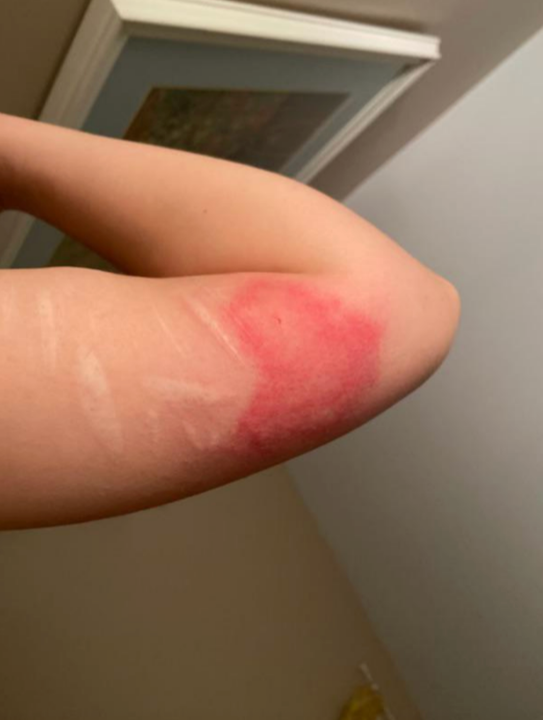 En arm som viser et hovent, rødt område, muligens en irritasjon