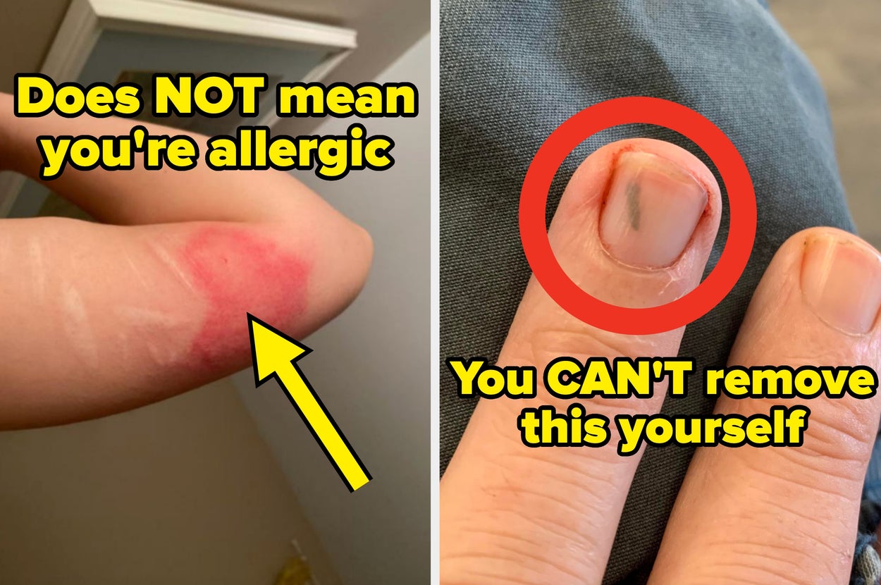 Left: Rash on arm caption: "Does NOT mean you're allergic;" right: Finger with splinter, caption: "You CAN'T remove this yourself"