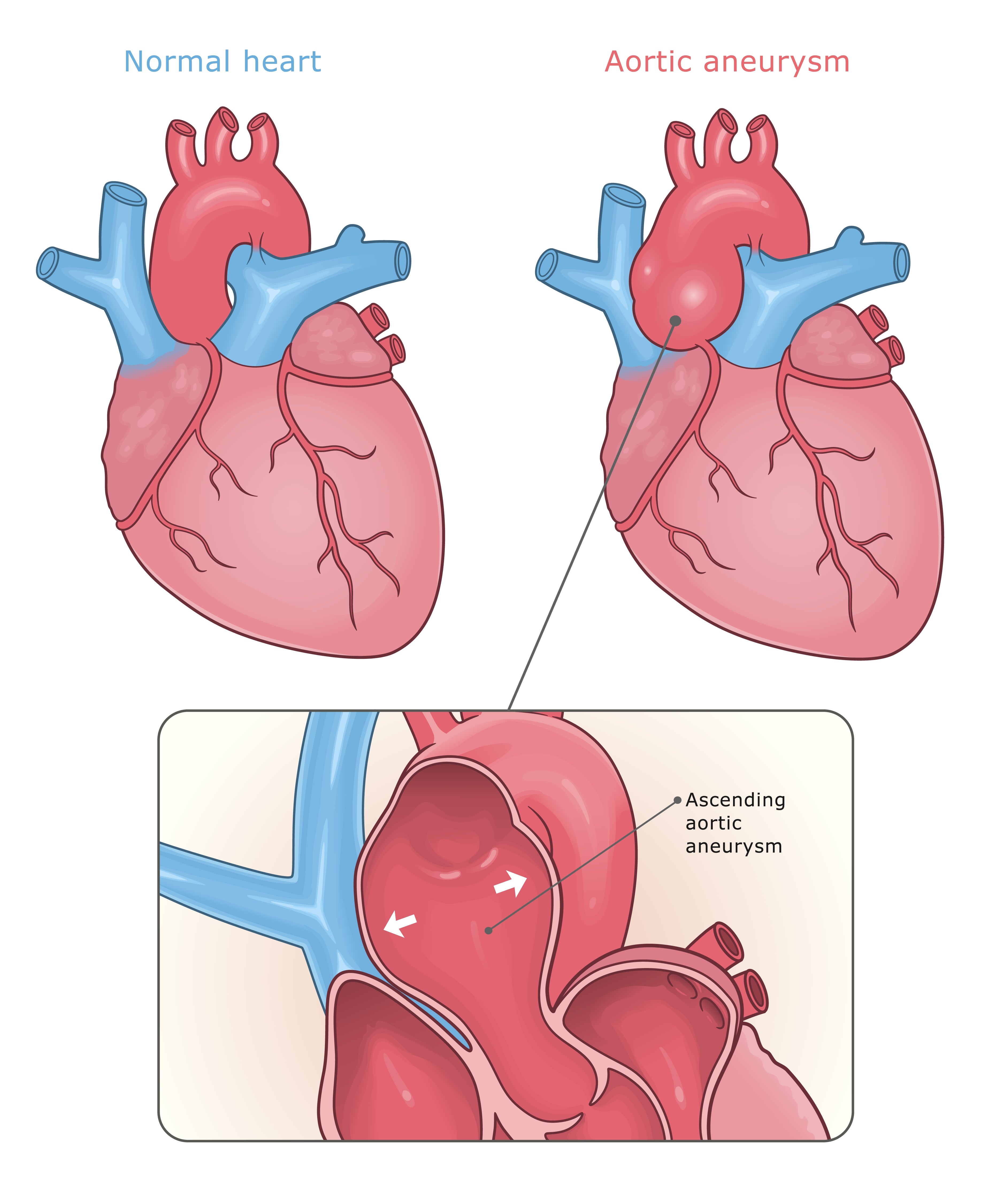 Diagram sammenligner et normalt hjerte med en med en aorta -aneurisme, og fremhever den forstørrede aorta -delen