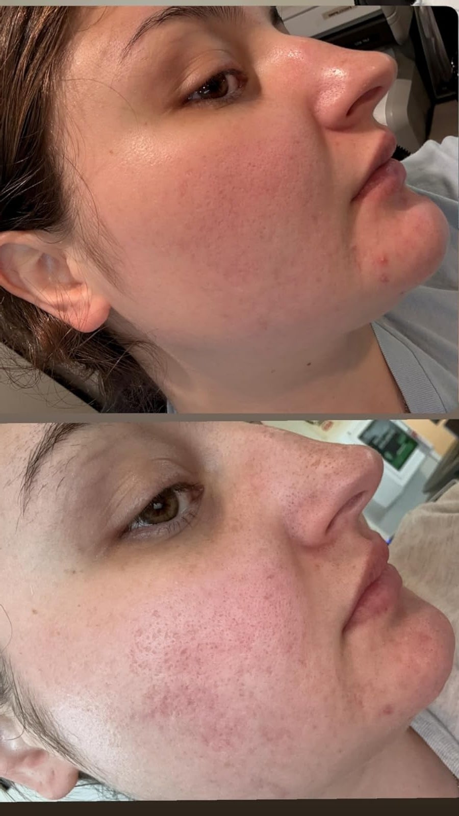 Two close-up side profile images showing a woman's skin before and after using a skincare product. Minimal visible change in texture