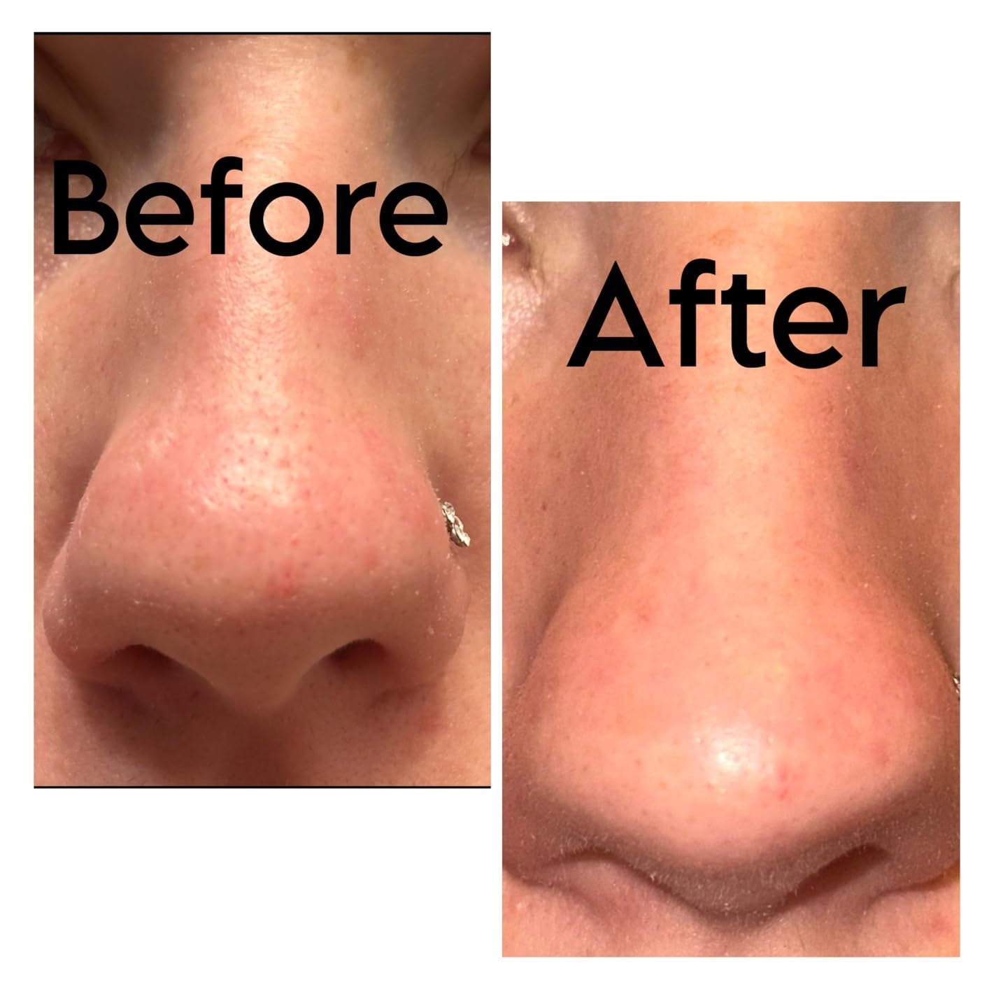 Close-up of a chemoreceptor  showing tegument  earlier  and aft  treatment, highlighting improved texture and reduced blemishes