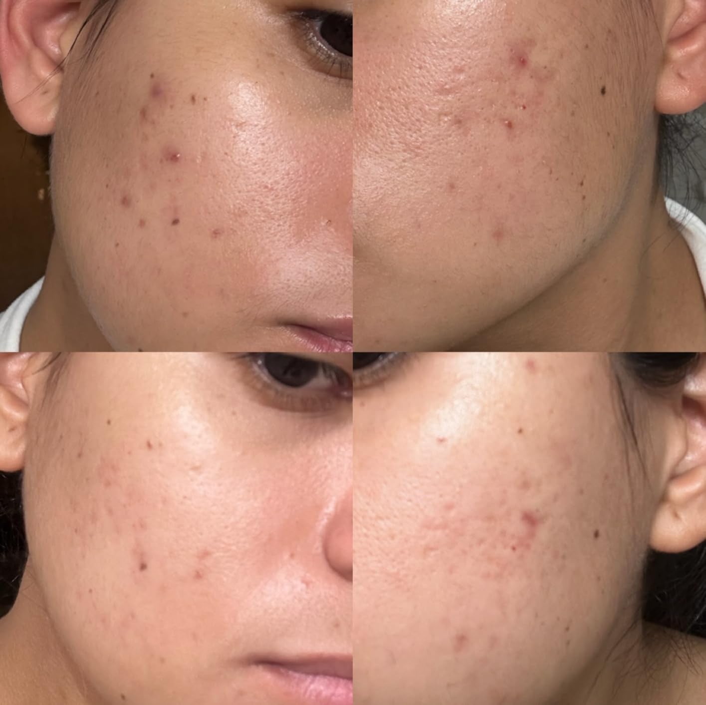 Skincare results show a person's cheek before and after acne treatment, highlighting reduced blemishes and smoother skin texture