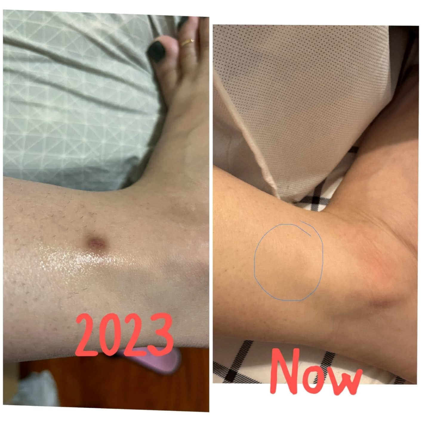 Two arms compared: left shows a scar in 2023; right shows the same area now healed, suggesting a skincare product's effectiveness