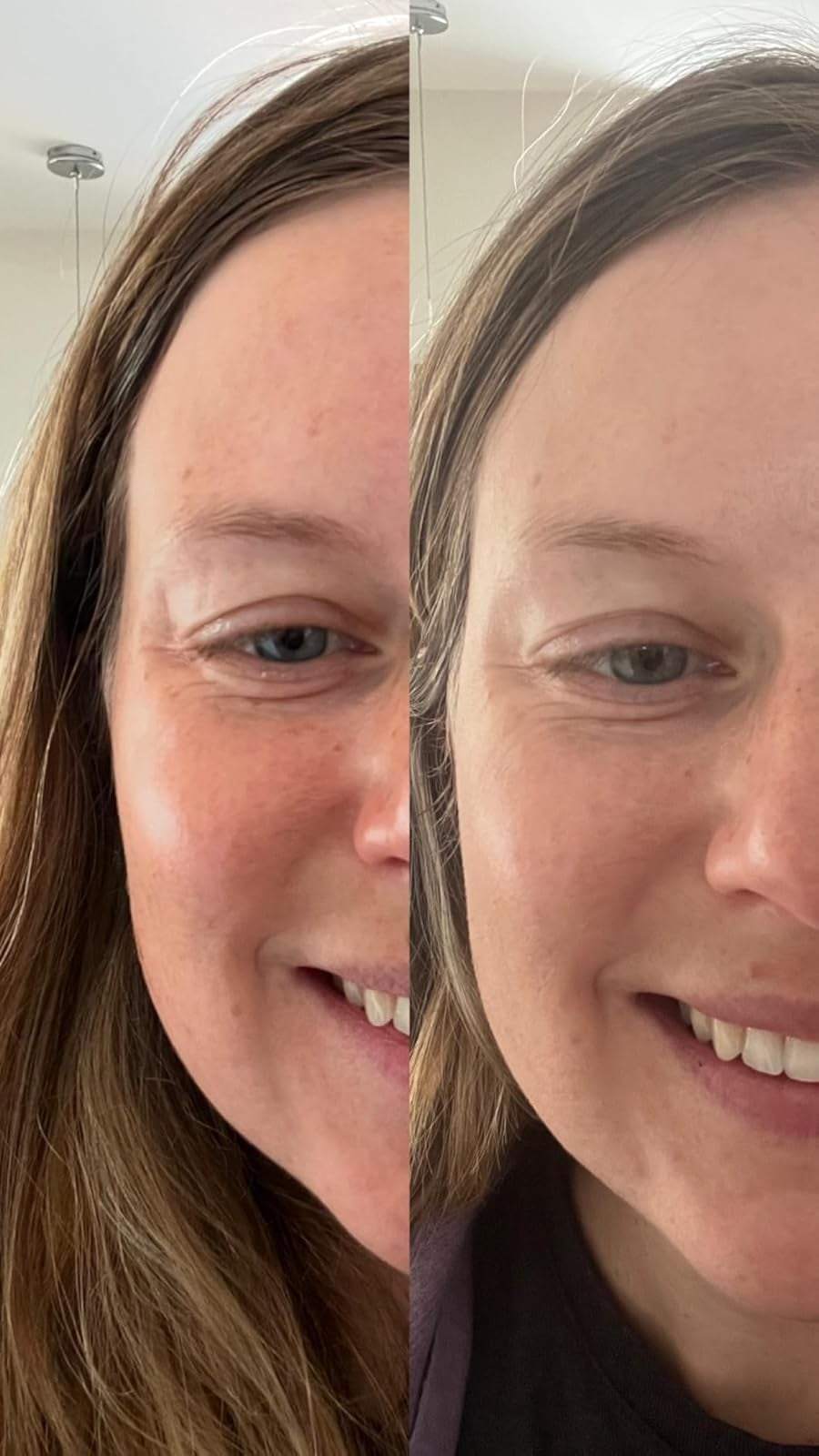 Split image comparison of a person's face showing skincare effects with visible changes in skin texture and smoothness