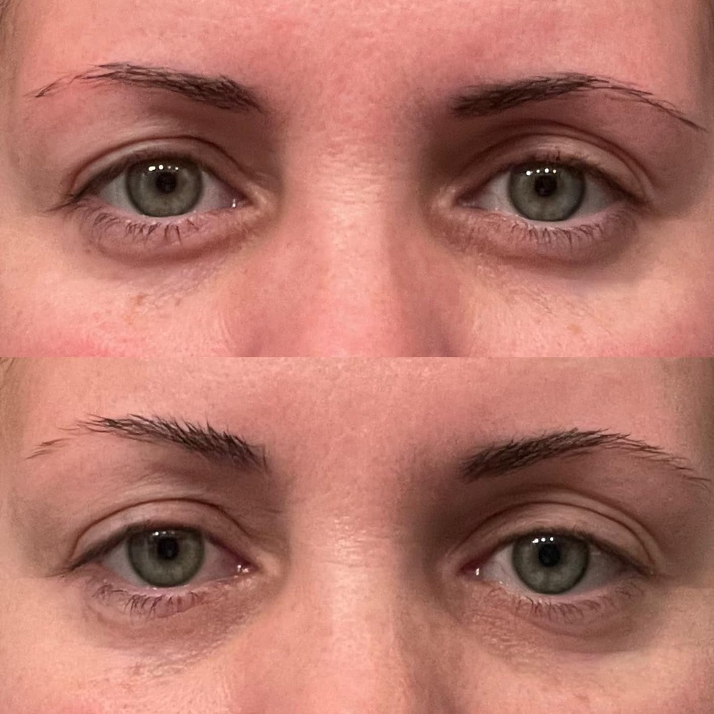 Close-up of a person's eyes showing before and after effects of a beauty treatment, highlighting changes in under-eyes