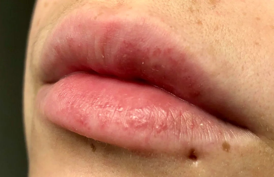 Nærbilde av en persons lepper og nedre ansikt, og fremhever naturlig hudtekstur og svake fregner