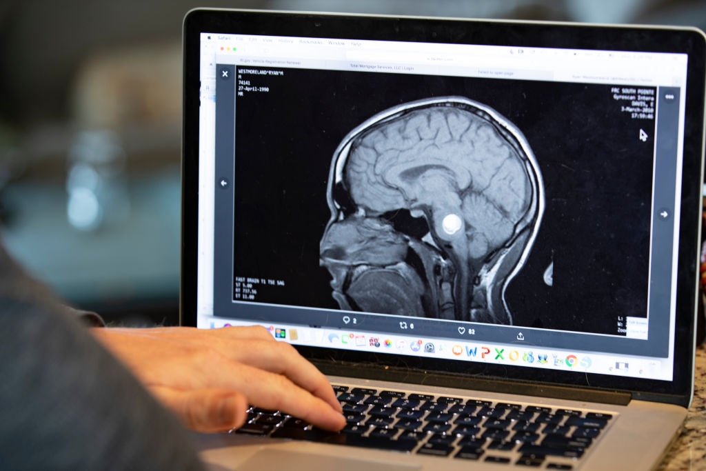 Person som analyserer en MR -hjerne på en bærbar skjerm, med fokus på et bestemt område. Hender synlig skriving på tastaturet