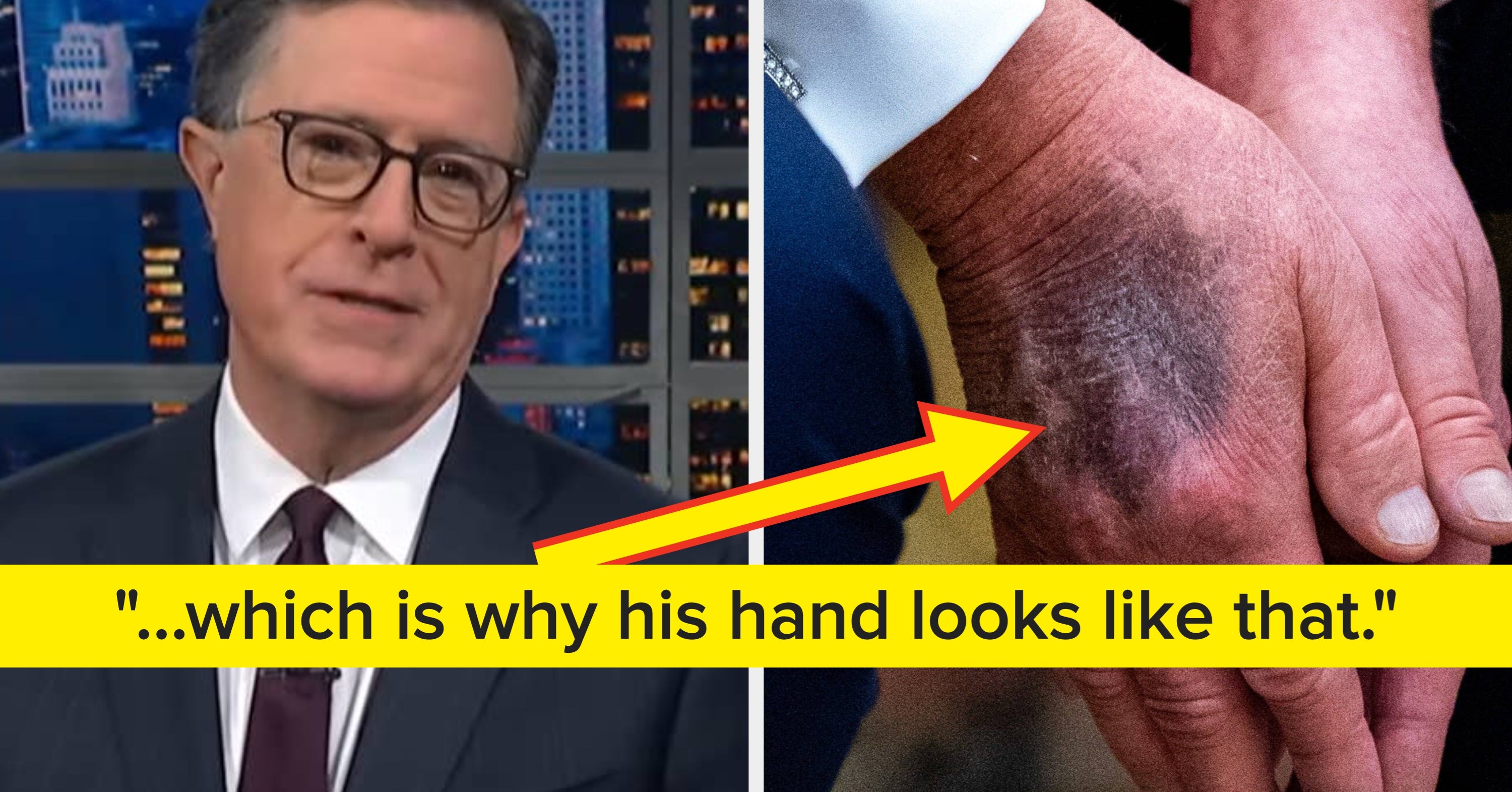 Stephen Colbert Shared His 1 Theory About Trump's Weird Hand Bruise