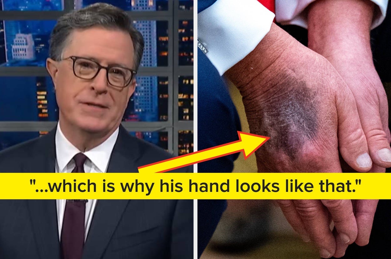Stephen Colbert Shared His 1 Burning Theory About That Bruise On Trump's Hand