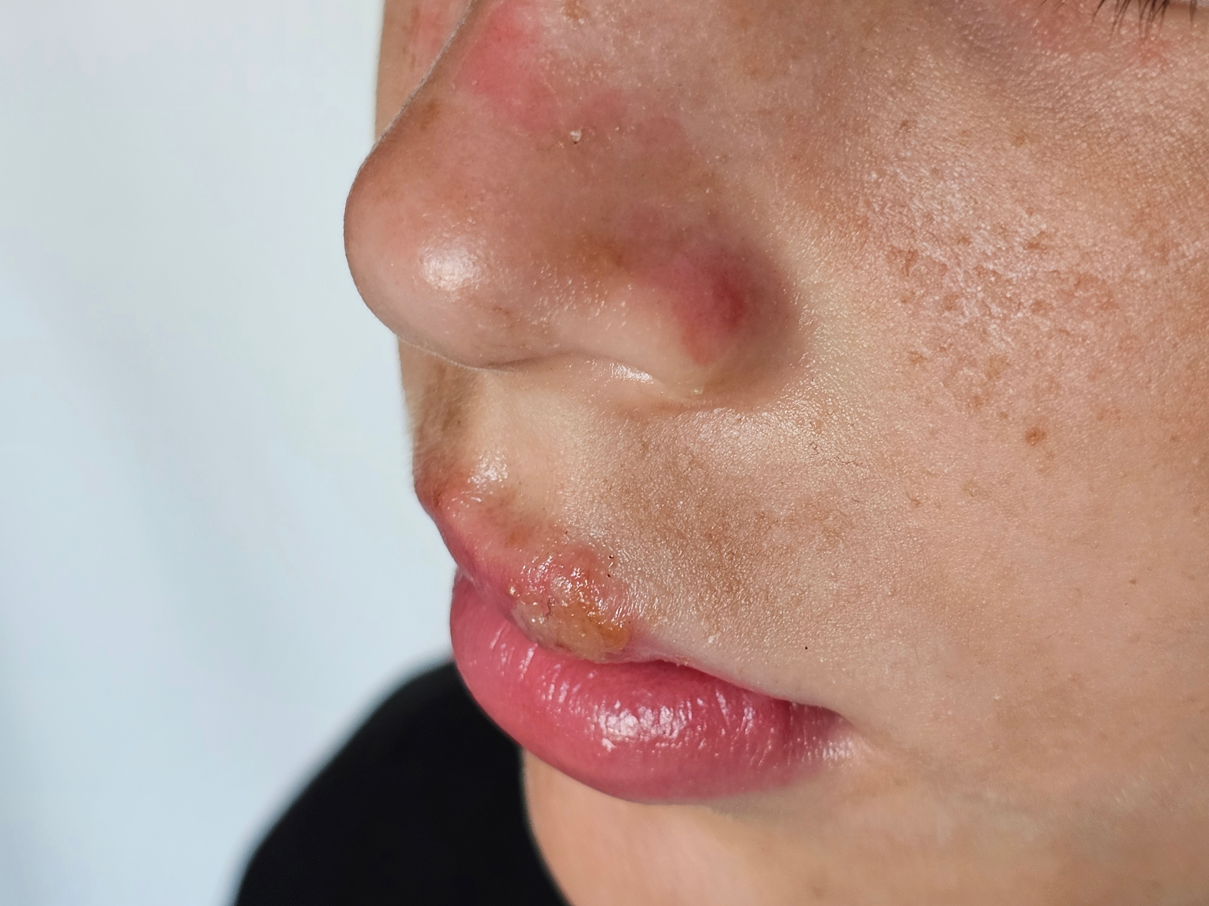 Nærbilde av en persons ansikt som viser et forkjølelsessår over leppen og akne på nesen