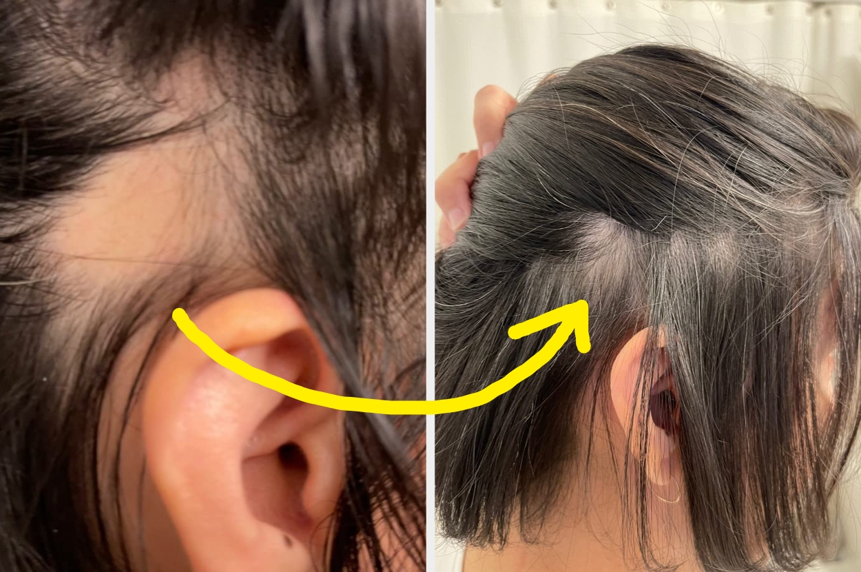 Close-up before and after images of hair showing noticeable improvement in regrowth near the ear and scalp