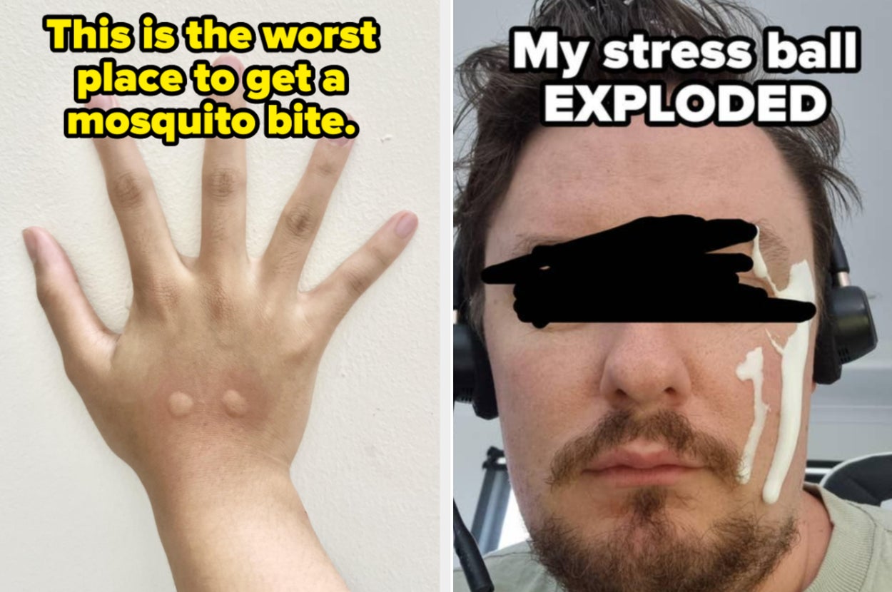 Split image: Left side shows a hand with mosquito bites labeled "worst place for mosquito bite." Right side shows a person with a broken stress ball