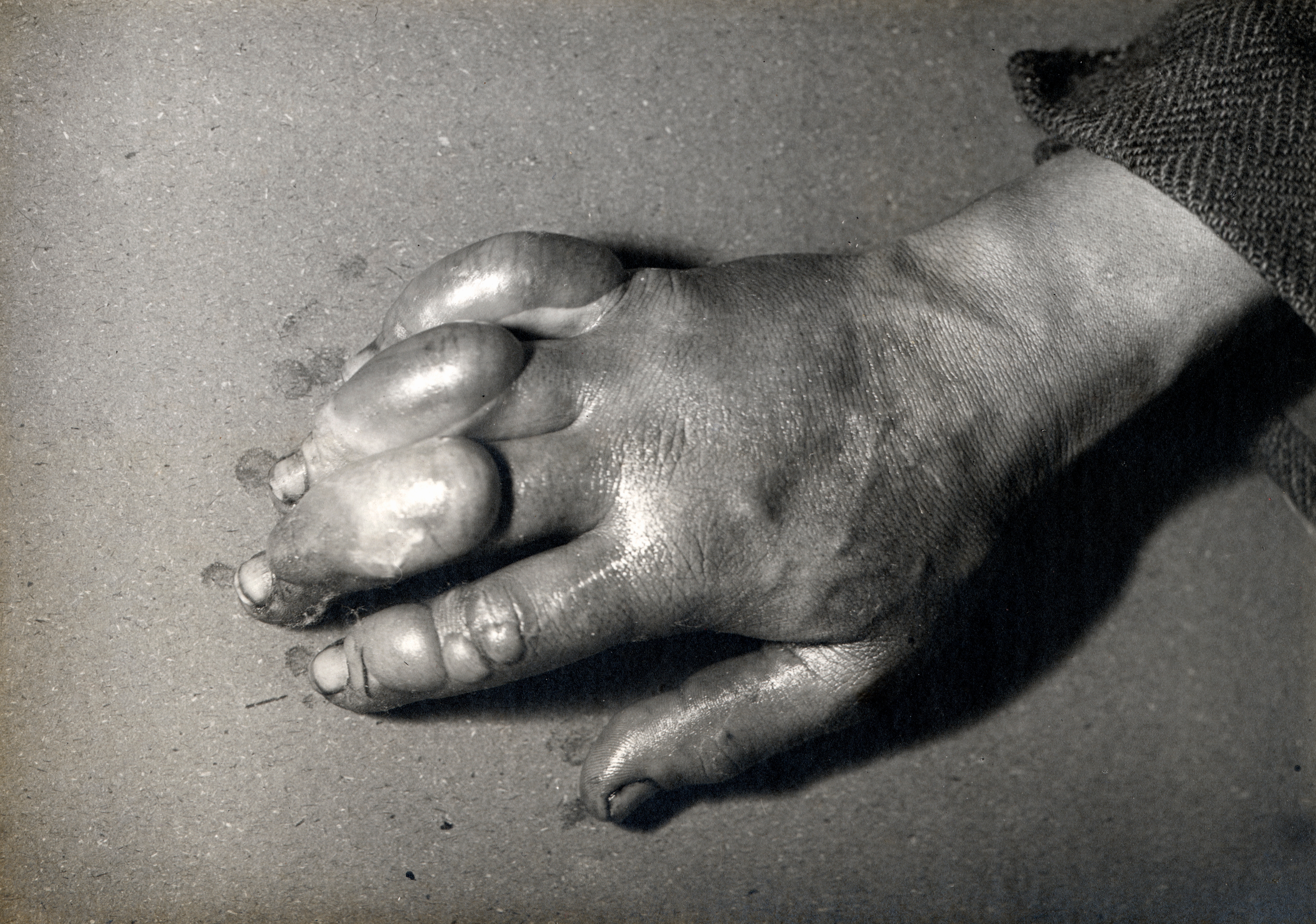 Close-up of a manus  with large, fluid-filled blisters oregon  swelling connected  the fingers, resting thenar  down   connected  a level  surface