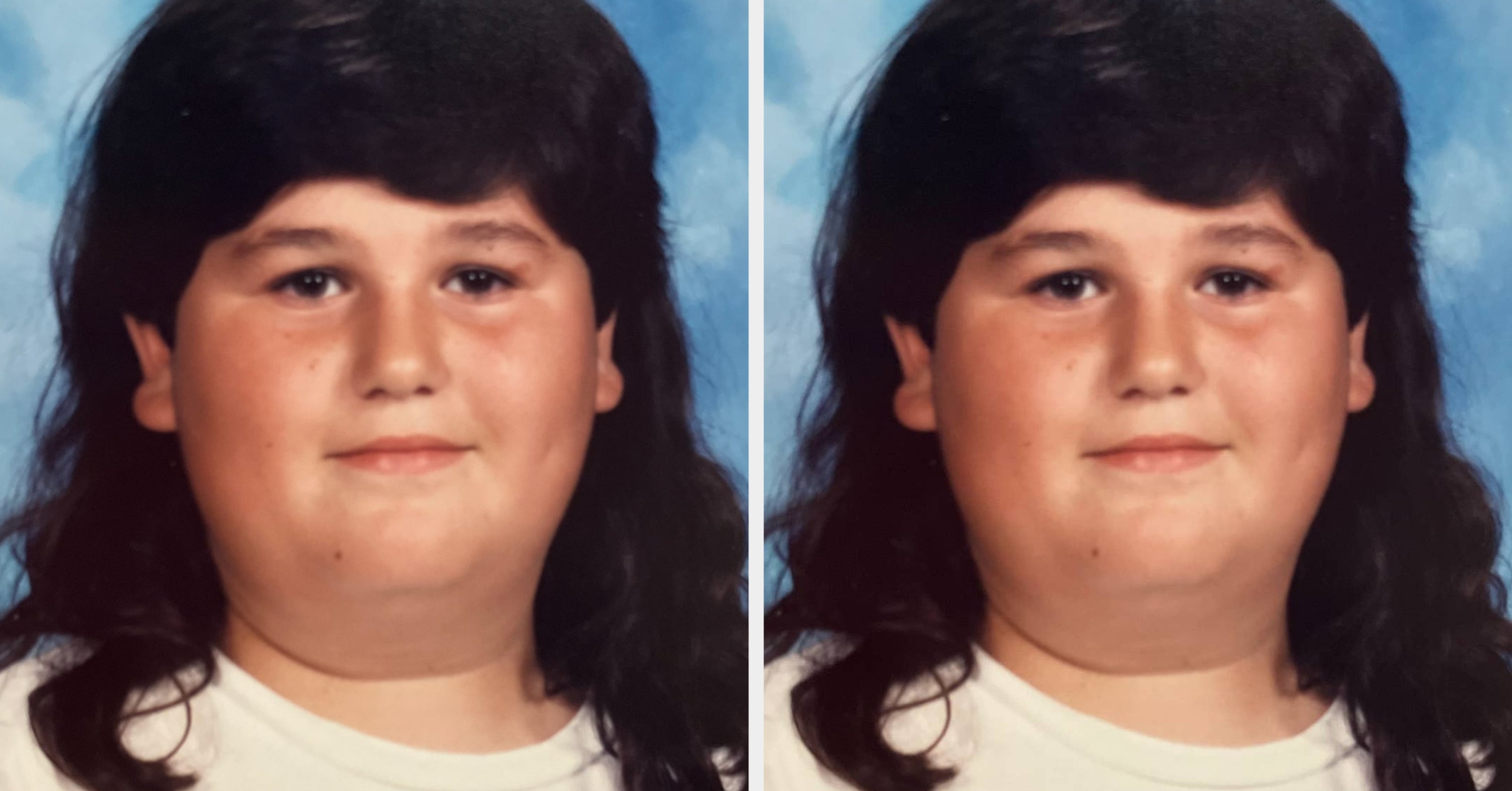 I Had My Stomach Stapled At 14 Years Old. That Surgery Didn't 'Cure' Me - Far From It.