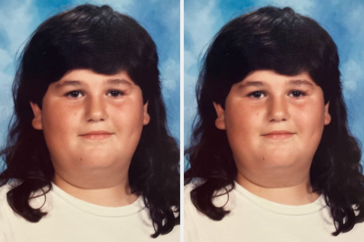 I Had My Stomach Stapled At 14 Years Old. That Surgery Didn't 'Cure' Me — Far From It.