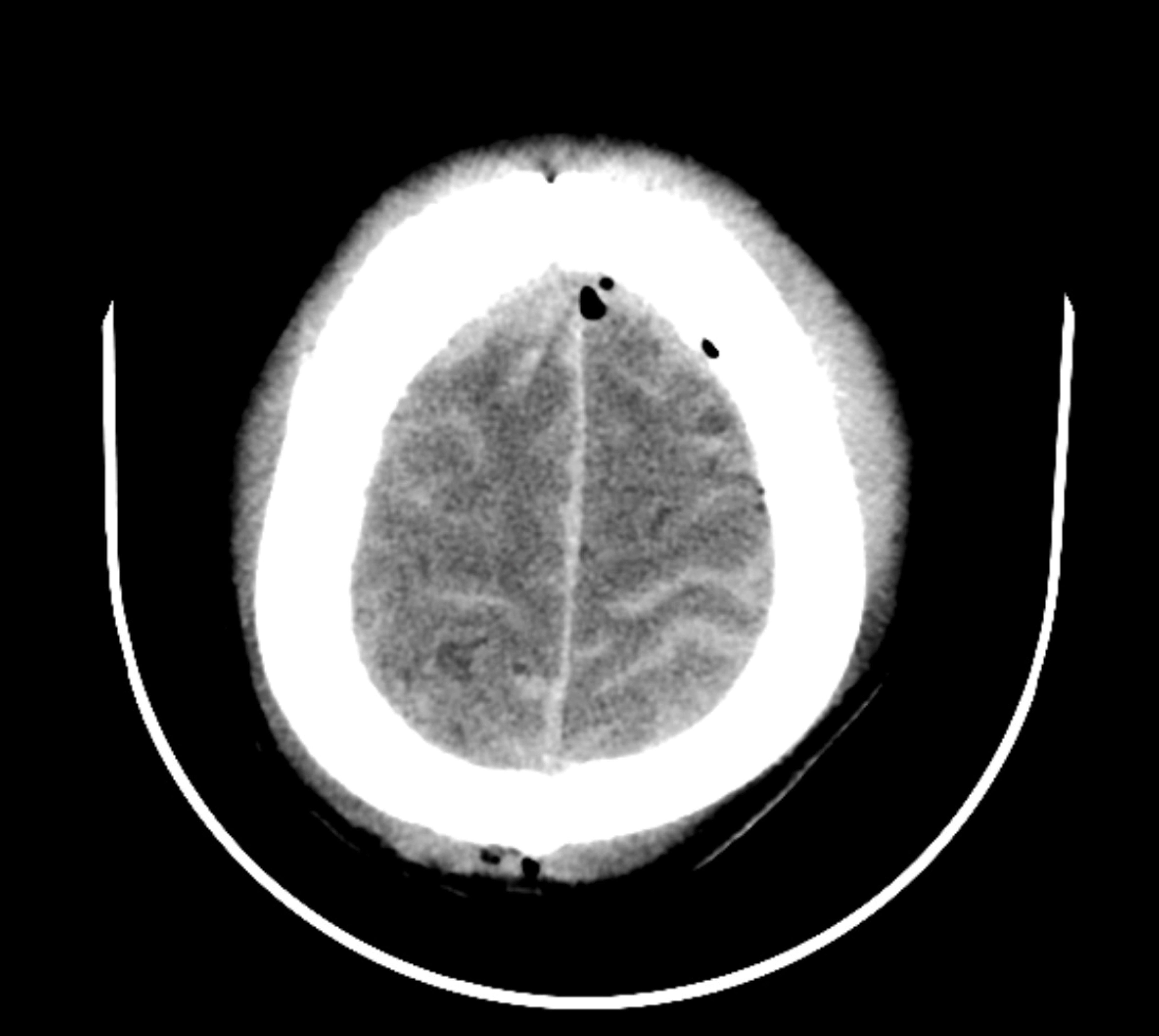 A aesculapian  encephalon  scan showing a cross-sectional view, highlighting the skull and interior   encephalon  structures