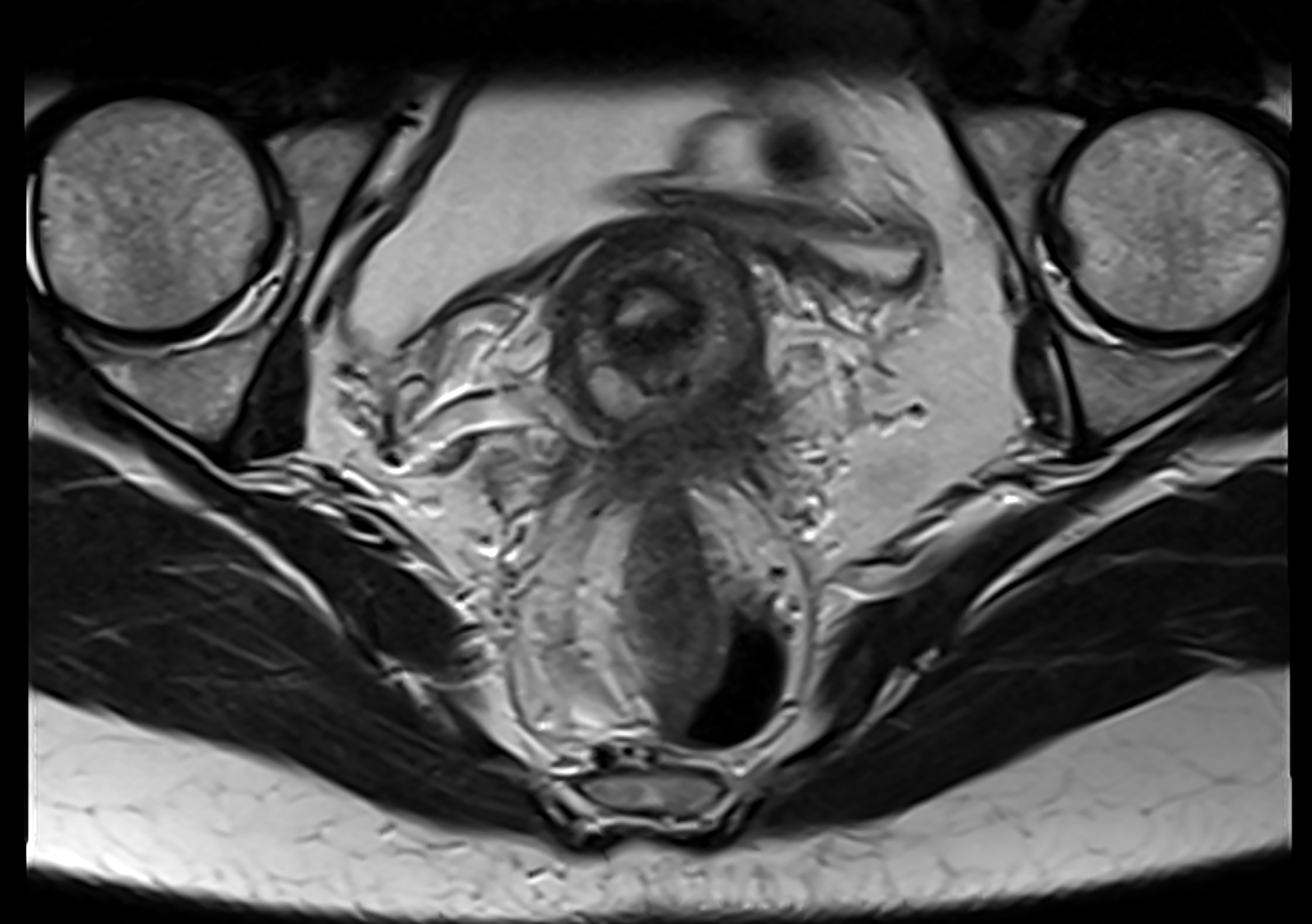 MRI scan showing a cross-section of quality  pelvic anatomy, with elaborate  structures disposable   for aesculapian  analysis
