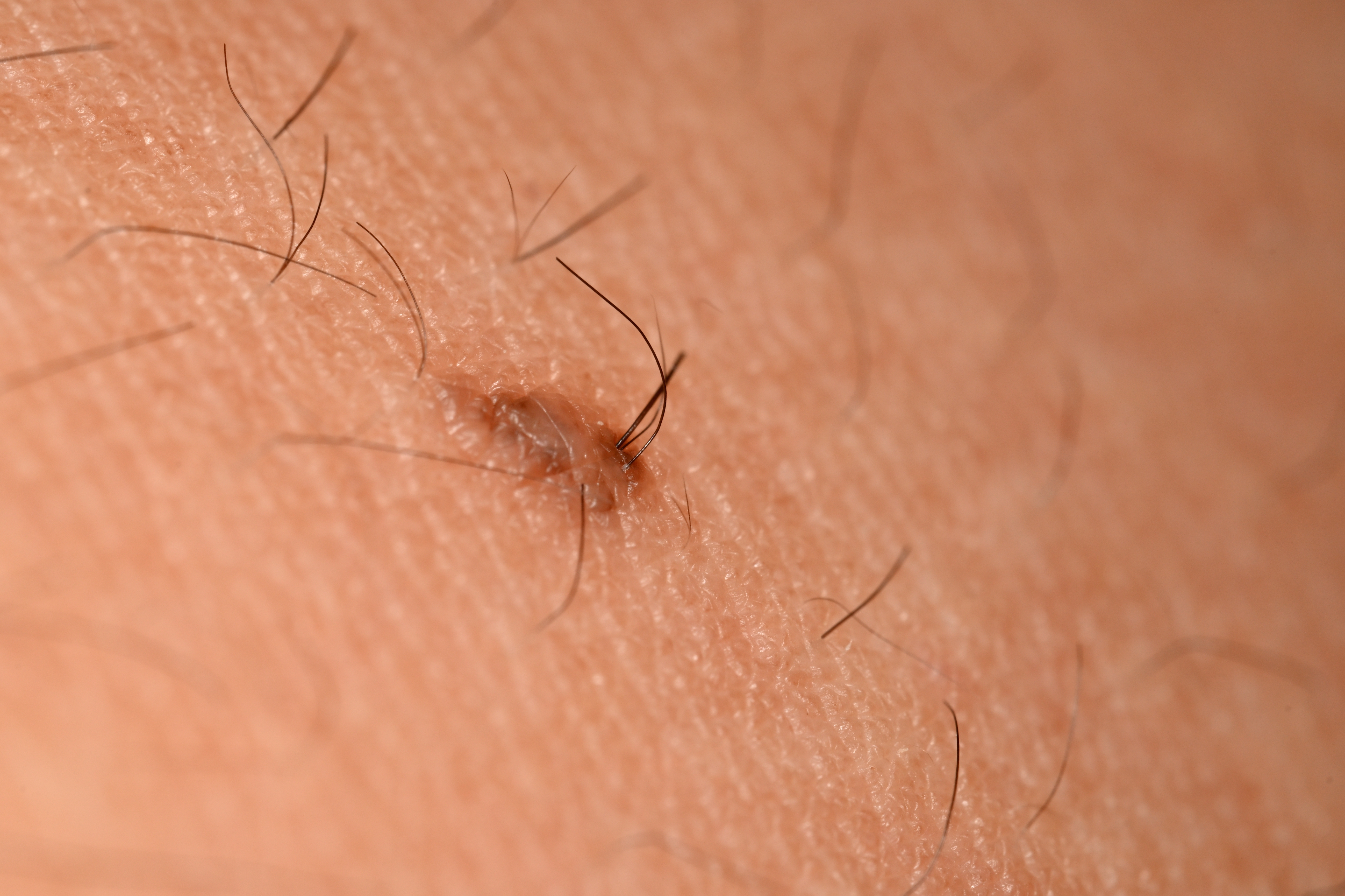 Close-up of a small, raised mole connected  the skin, surrounded by good  hairs