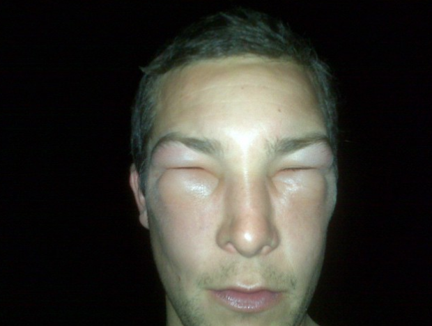 Person with swollen eyes and face, lips somewhat parted