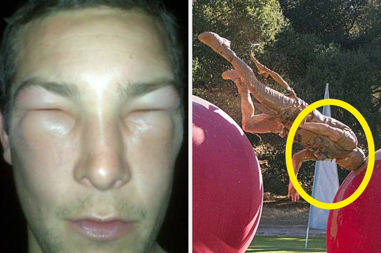 Left: Person with facial swelling and closed eyes. Right: Dinosaur sculpture on large red spheres in a park setting