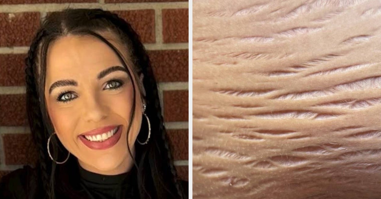 This Mom's "Deep" Stretch Marks Are Going Viral, And Nearly 50 Million People Are, Once Again, Completely Mesmerized By What The Female Body Is Capable Of