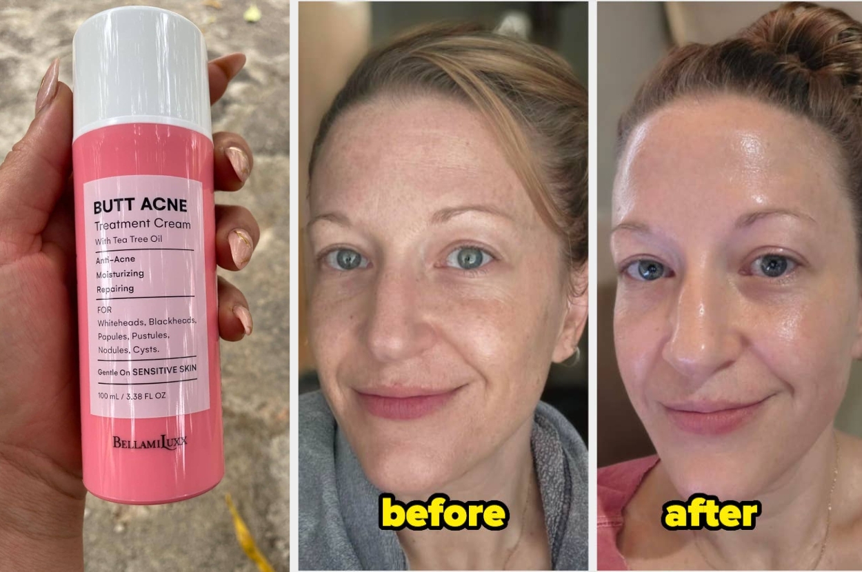 Skincare product labeled "Butt Acne Treatment Cream" shown with before-and-after photos of a woman's face, indicating clear skin improvement