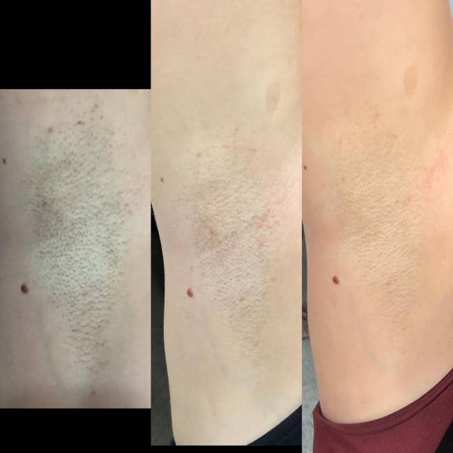 Three side-by-side close-up views of a person's armpit showing a reduction in hair growth