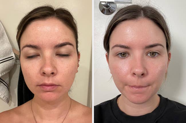 Side-by-side comparison of a person's skincare routine results, showing skin improvement