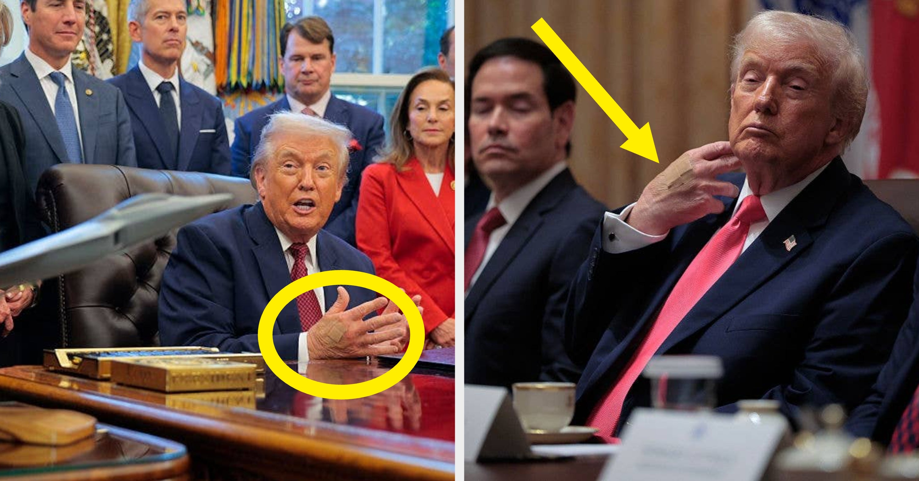 Here's What Trump's Hand Looked Like Every Day This Week