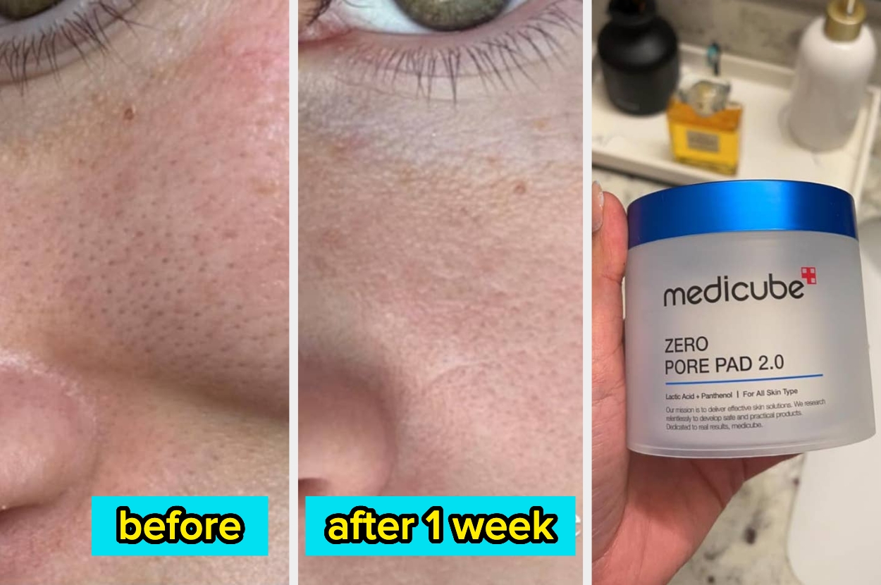 Close-up of skin showing improved texture after using Medicube Zero Pore Pad 2.0 for one week; product container is held next to skincare items
