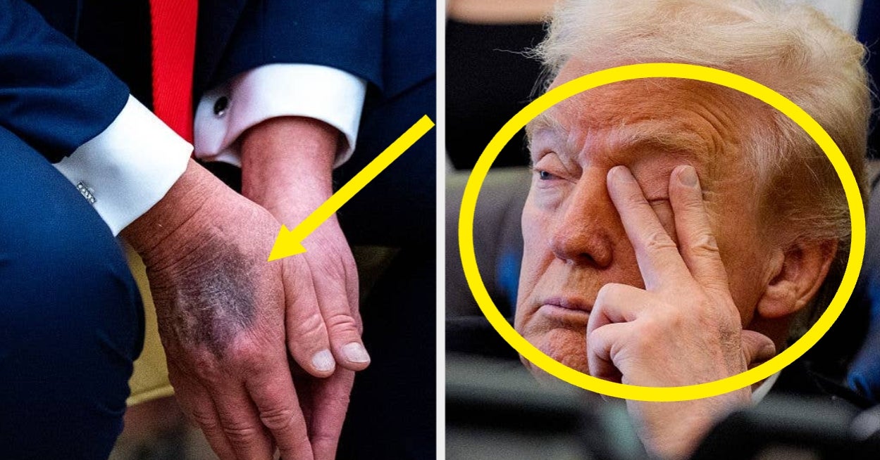 Sooo, Donald Trump Spoke Out About The Photos Of His Bruised Hands And Closed Eyes