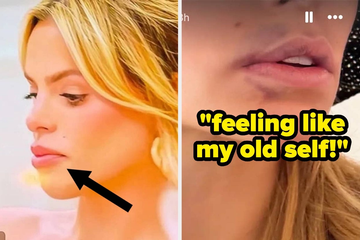Brooks Nader Said She’s Feeling Like Her “Old Self” After Having Her Lip Filler Dissolved, And These Before-And-After Pics Are Fascinating