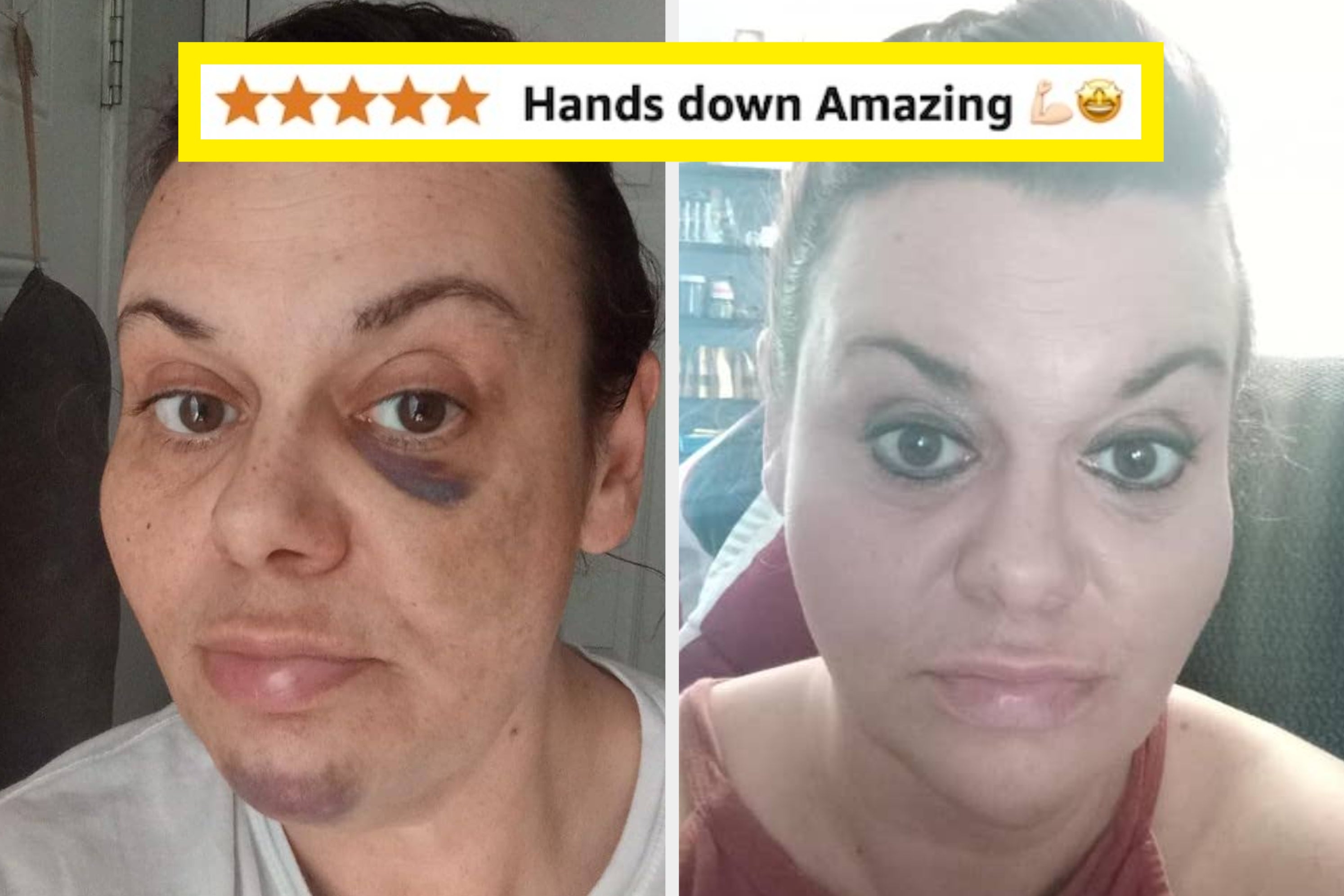 Two side-by-side photos show a woman's face with and without bruise-like makeup, showcasing a concealer's effectiveness with an "amazing" 5-star review