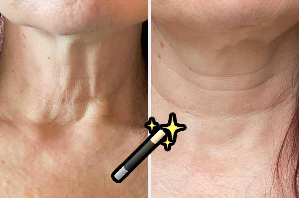 Before and after comparison of neck with improved skin texture; magic wand icon symbolizes transformation