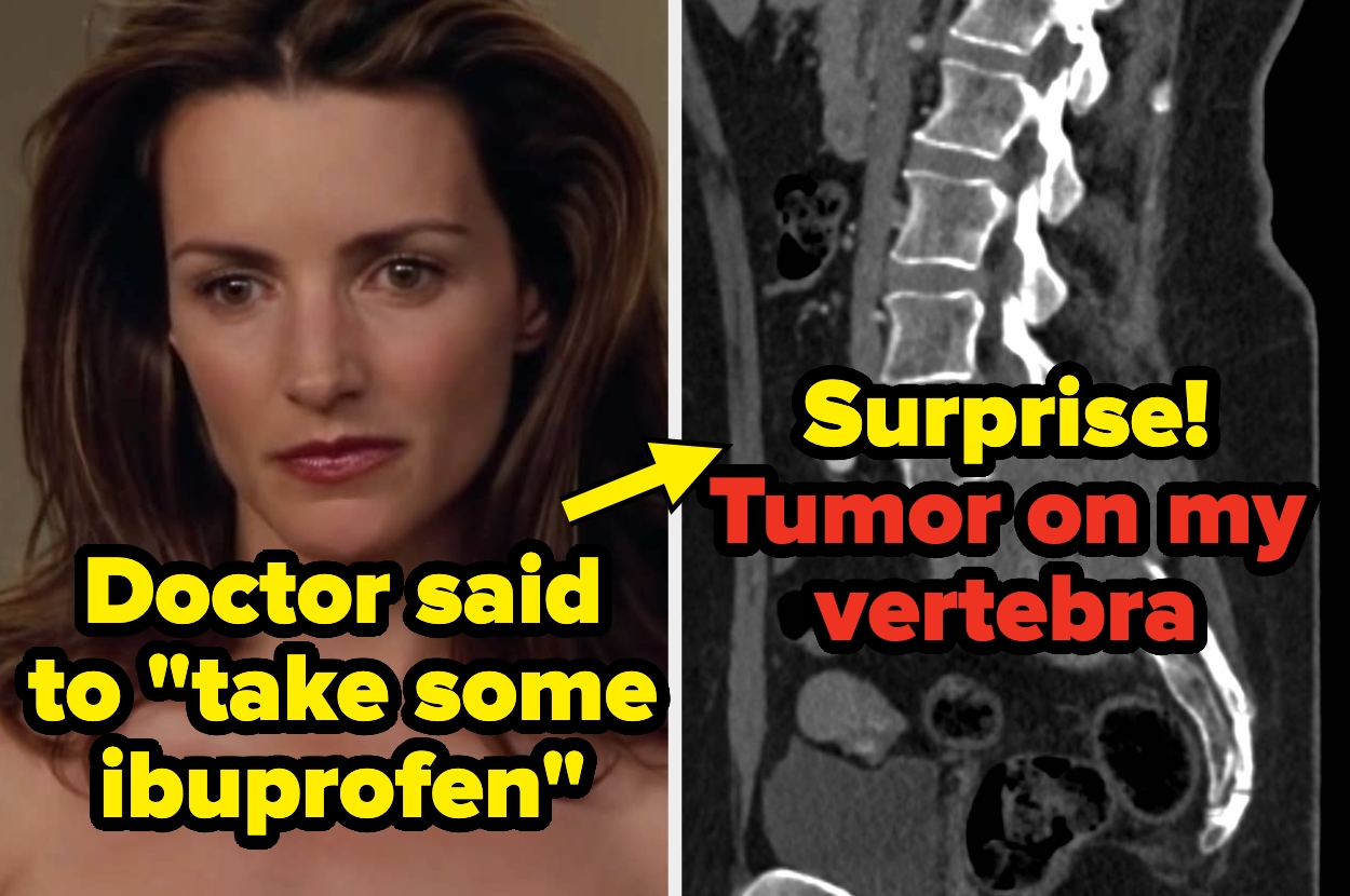 Woman looks serious; text overlaid about doctor suggesting ibuprofen. Adjacent image shows a spinal scan with a tumor highlighted