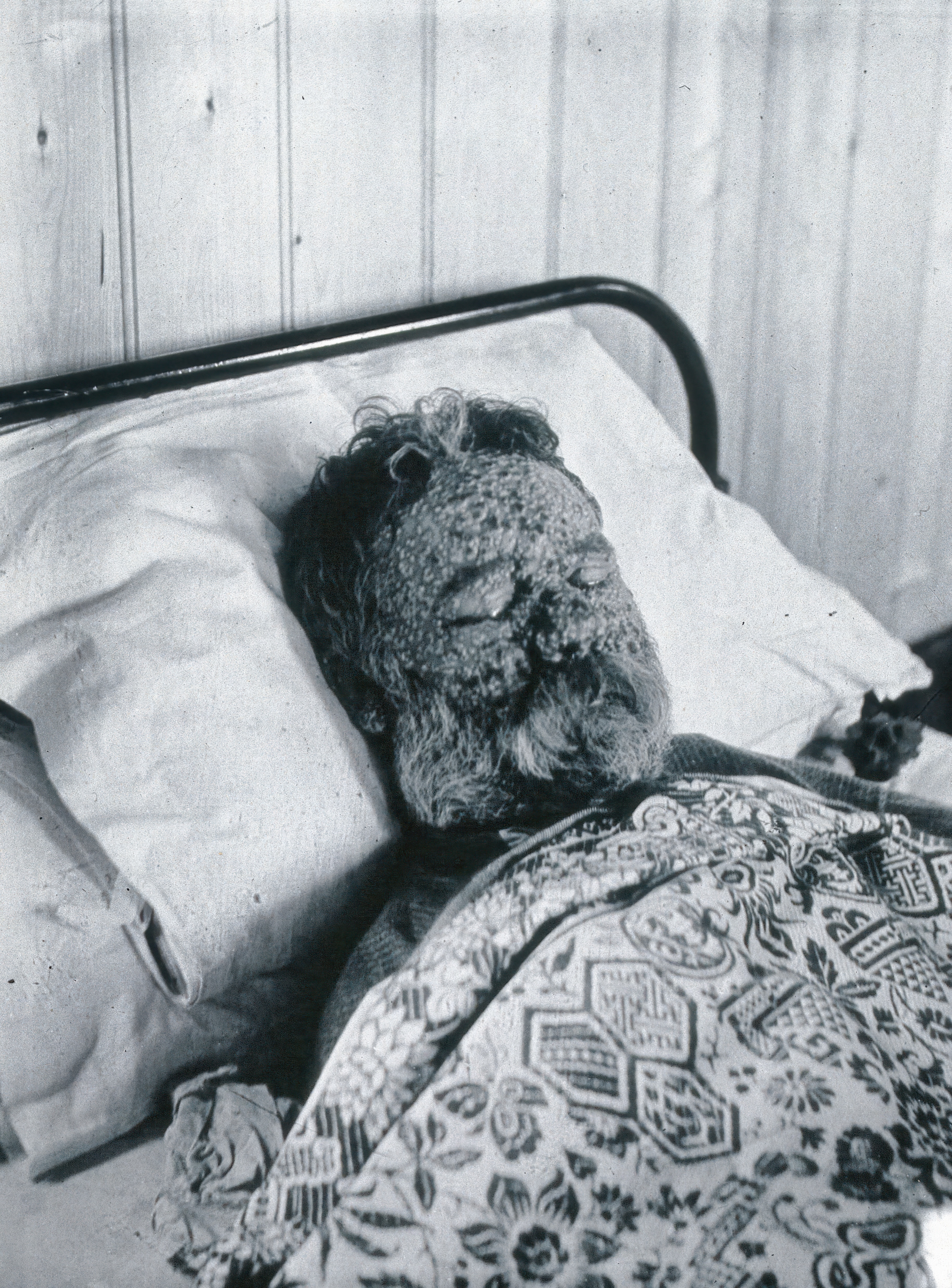 A person lies in bed with a severely pockmarked face, possibly affected by a skin condition, and covered by a patterned blanket