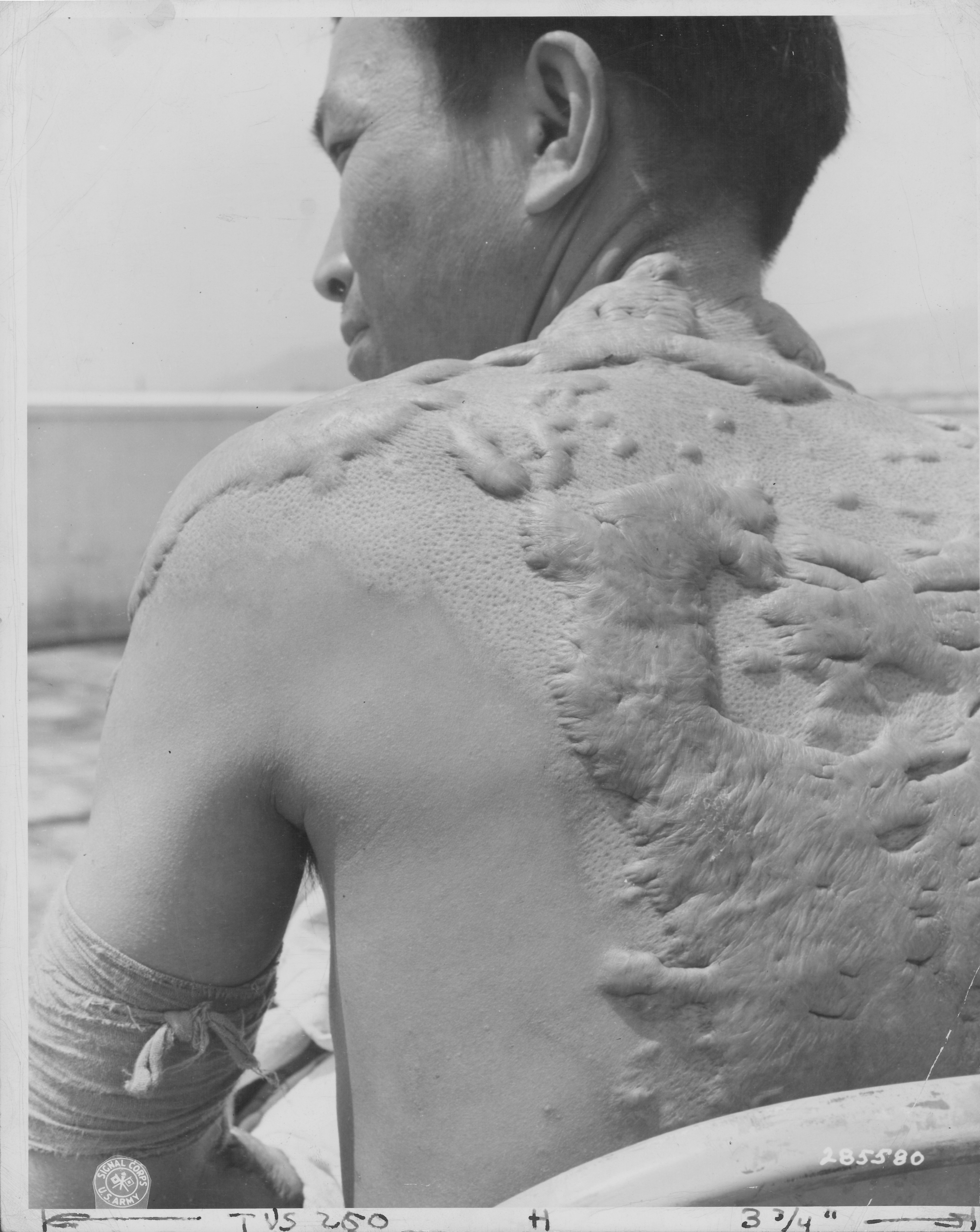 A person showing large keloid scars on their back and shoulder, facing away from the camera