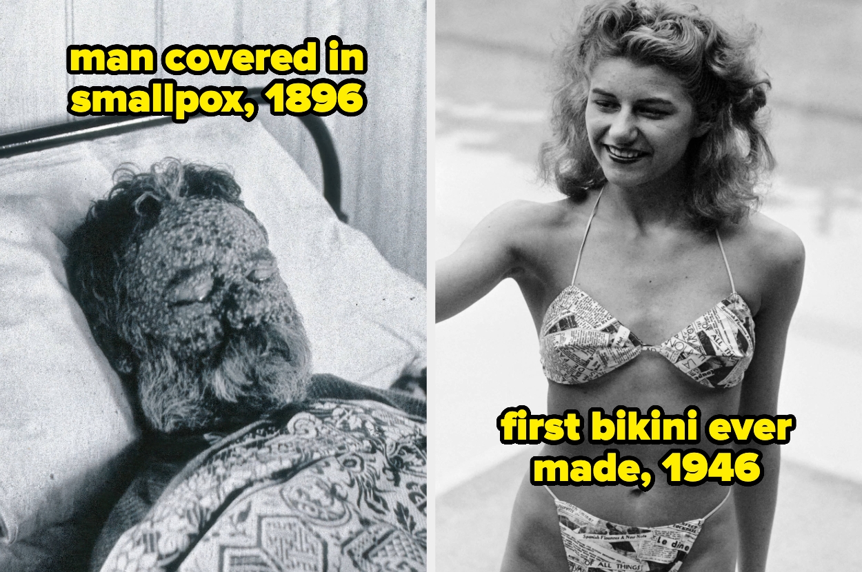 On the left, a man with smallpox in 1896. On the right, a woman wearing the first bikini ever made in 1946, featuring a newspaper print design