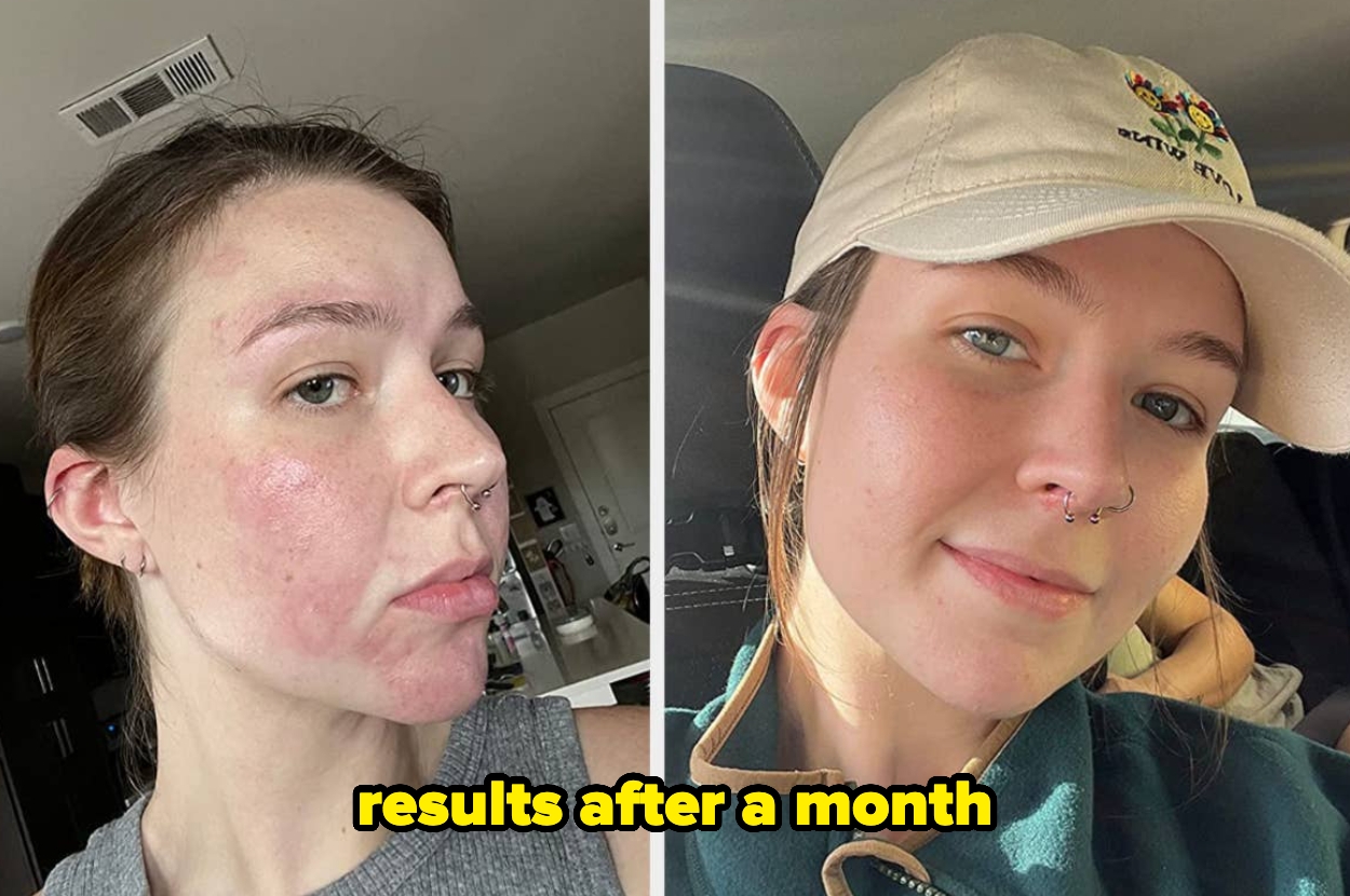 Side-by-side images of a reviewer before and after, showing improved skin texture and reduced redness with text "results after a month"
