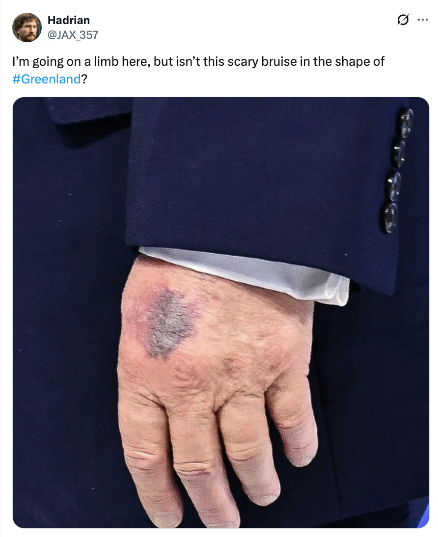 A hand with a visible bruise that resembles the shape of Greenland