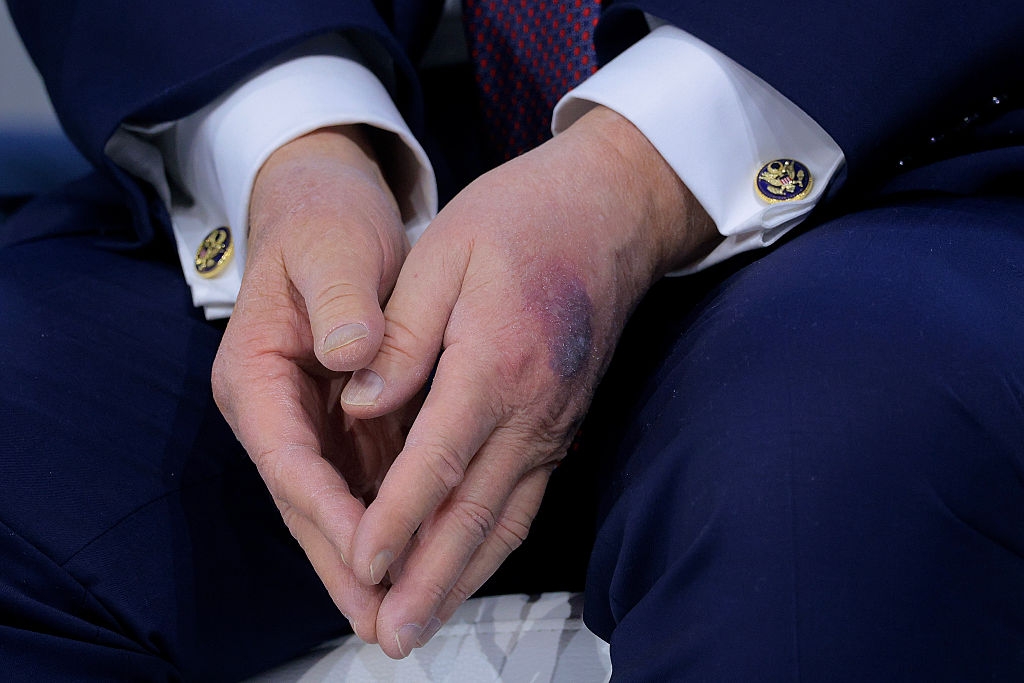 A person's hands are clasped together, showing a bruise on one hand. The person is wearing a suit with cufflinks