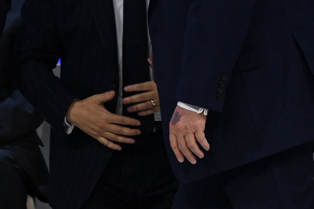 Two individuals in formal suits are standing close, focusing on their hands. One hand shows a prominent bruise or marking on the skin
