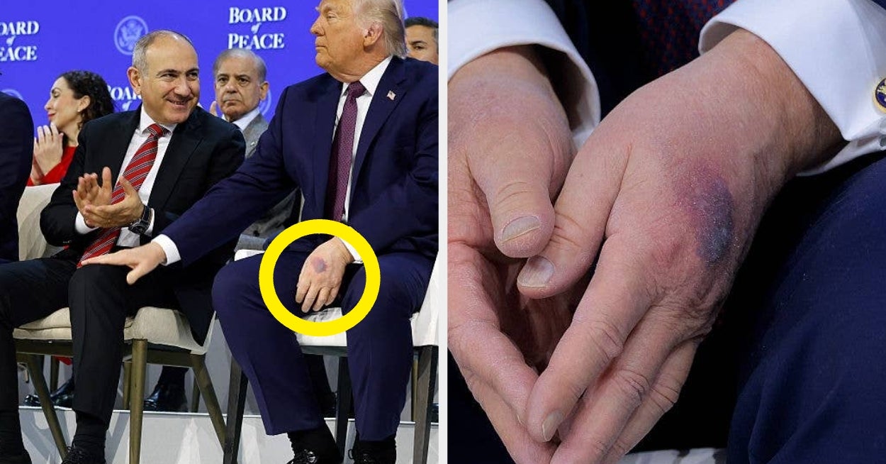 Trumps Erklärung für den neuen Handbluterguss sorgt für Aufsehen