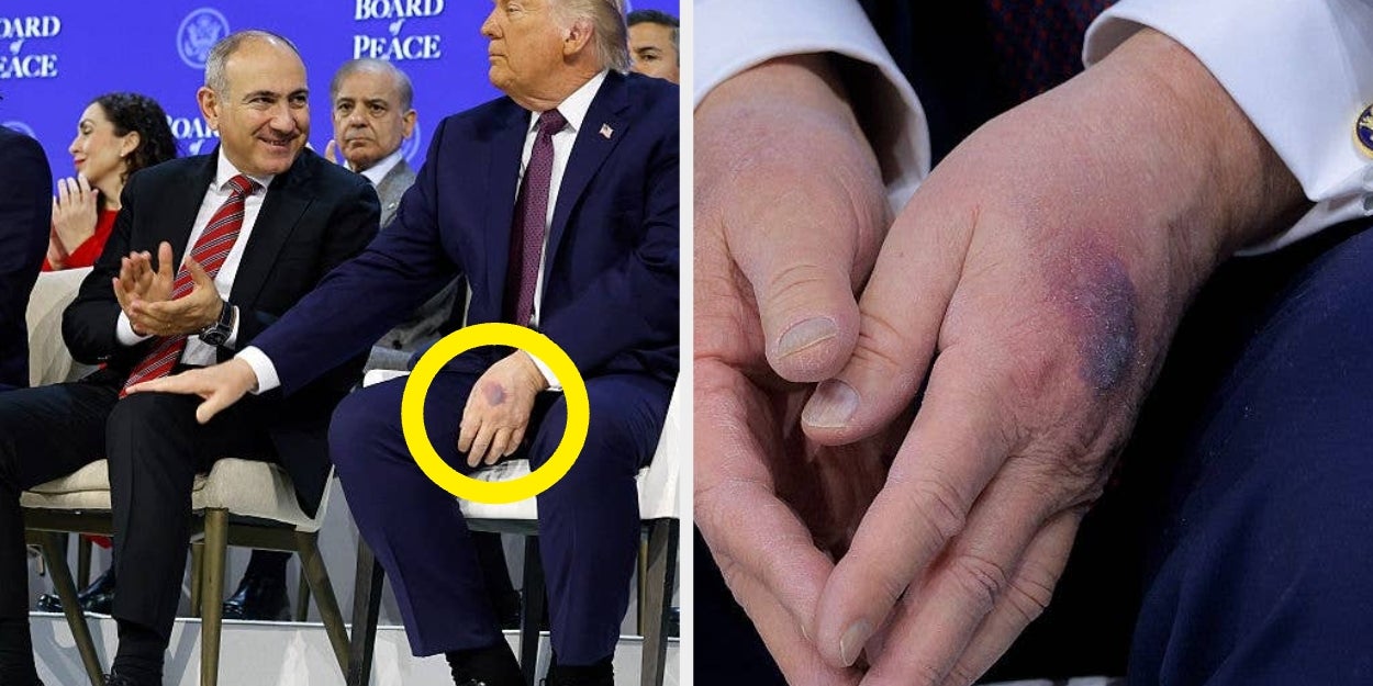 Trump’s Explanation For That New Hand Bruise Is Raising A Lot Of Eyebrows